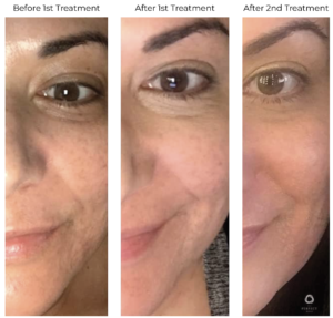 chemical peels before and after